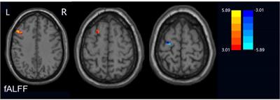 Frontiers | Altered Spontaneous Neural Activity In Peripartum ...